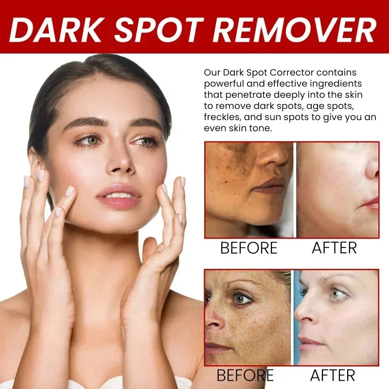 Freckle Removing Cream Women Face Quick Dark Spots Pigmentation Remove Whitening Cream Fade Melasma Brighten Cream for Dark Skin
