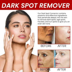 Freckle Removing Cream Women Face Quick Dark Spots Pigmentation Remove Whitening Cream Fade Melasma Brighten Cream for Dark Skin