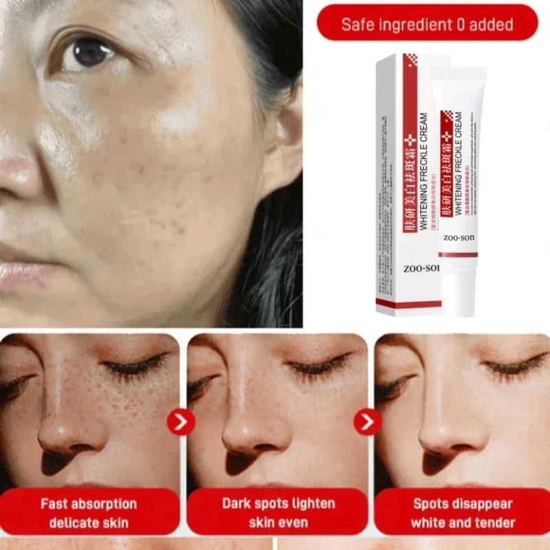 Freckle Removing Cream Women Face Quick Dark Spots Pigmentation Remove Whitening Cream Fade Melasma Brighten Cream for Dark Skin