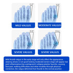 Adjustable Unisex Bunion Foot Adjuster Hallux Valgus Braces Rotatable Toe Separator Straightener Pedicure Finger Toe Adjuster