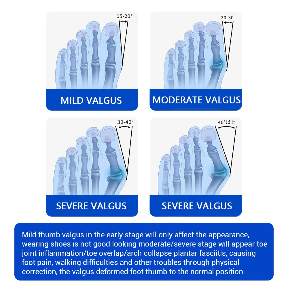 Adjustable Unisex Bunion Foot Adjuster Hallux Valgus Braces Rotatable Toe Separator Straightener Pedicure Finger Toe Adjuster