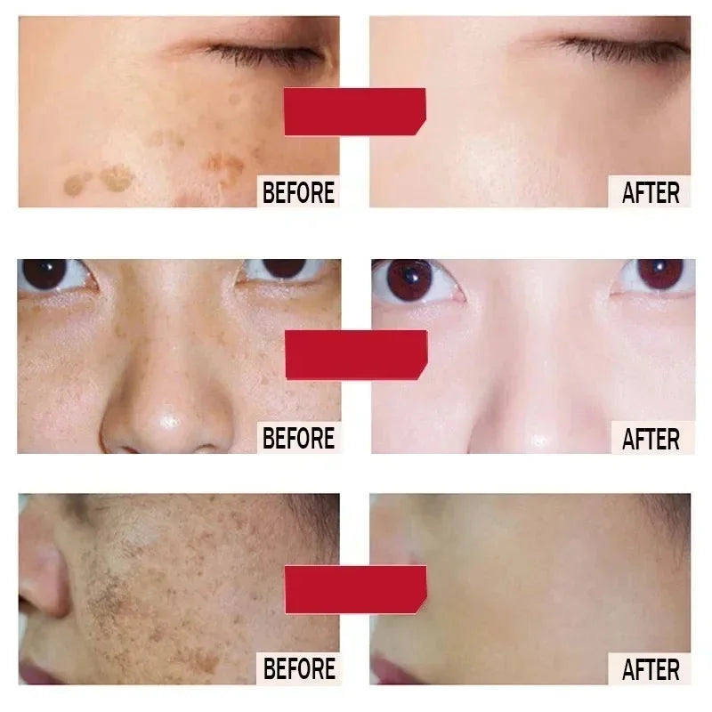 Freckle Removing Cream Women Face Quick Dark Spots Pigmentation Remove Whitening Cream Fade Melasma Brighten Cream for Dark Skin