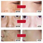 Freckle Removing Cream Women Face Quick Dark Spots Pigmentation Remove Whitening Cream Fade Melasma Brighten Cream for Dark Skin