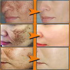 Freckle Removing Cream Women Face Quick Dark Spots Pigmentation Remove Whitening Cream Fade Melasma Brighten Cream for Dark Skin