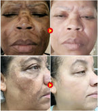 Freckle Removing Cream Women Face Quick Dark Spots Pigmentation Remove Whitening Cream Fade Melasma Brighten Cream for Dark Skin